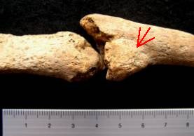 left ulna showing healed fracture