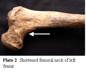 shortened femoral neck of left femur
